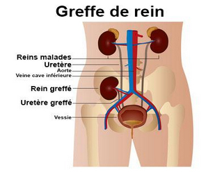 Greffe du rein